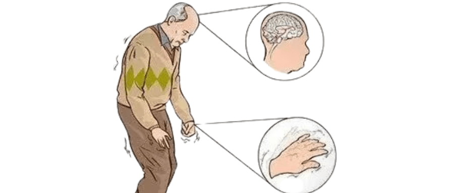 帕金森的药物种类