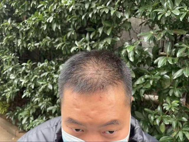 “还能反光<strong></p>
<p>债券交易市场构成</strong>!”长沙男子植发近9月称后脑勺“像狗啃过”