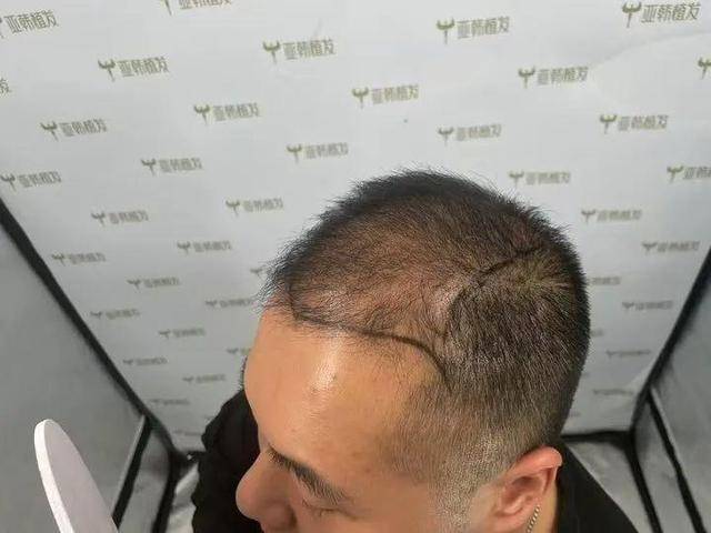 “还能反光<strong></p>
<p>债券交易市场构成</strong>!”长沙男子植发近9月称后脑勺“像狗啃过”