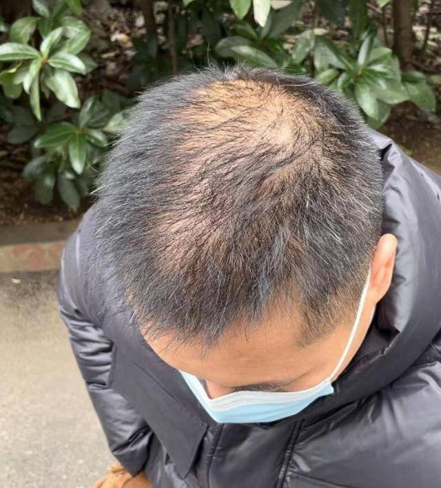 “还能反光<strong></p>
<p>债券交易市场构成</strong>!”长沙男子植发近9月称后脑勺“像狗啃过”