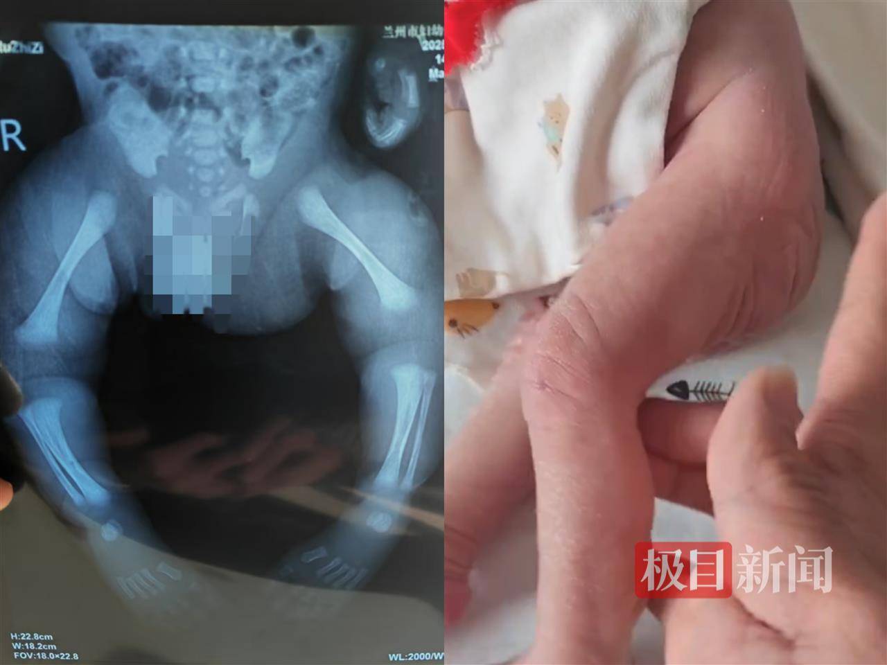 二胎出生查出先天性病症或落下残疾<strong></p>
<p>原油直播喊单</strong>，残疾父母称医院产检漏检、未尽告知义务，医院及医调委回应