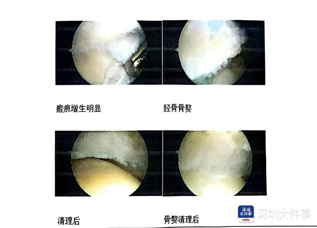 “一走路就痛”!女子脚踝受伤遭漏诊<strong></p>
<p>原油加盟</strong>,治了7年没好!深圳一医院被告上法庭