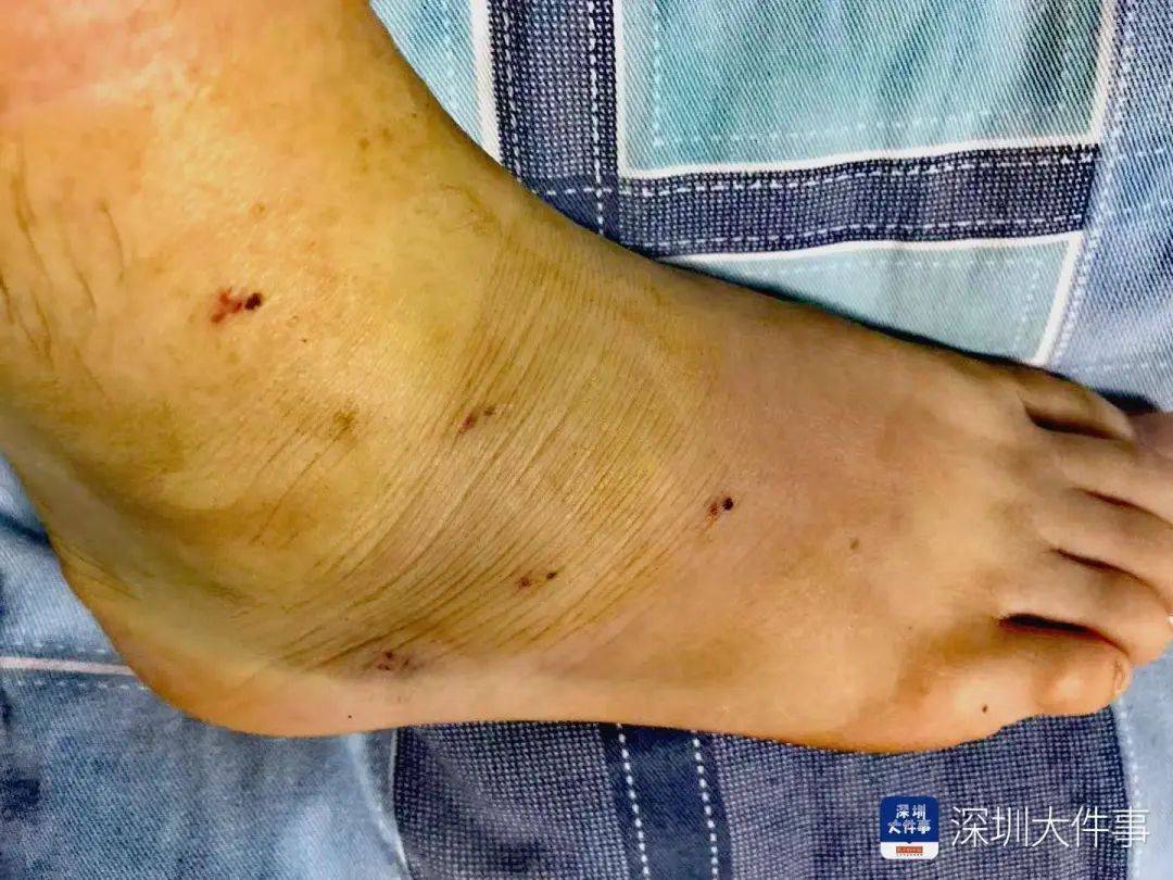 “一走路就痛”!女子脚踝受伤遭漏诊<strong></p>
<p>原油加盟</strong>,治了7年没好!深圳一医院被告上法庭