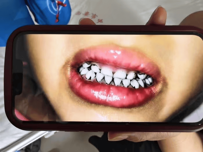 家长接到劝返电话“回甘肃去治”<strong></p>
<p>原油新闻最新消息</strong>,幼儿血铅中毒事件更多细节曝光