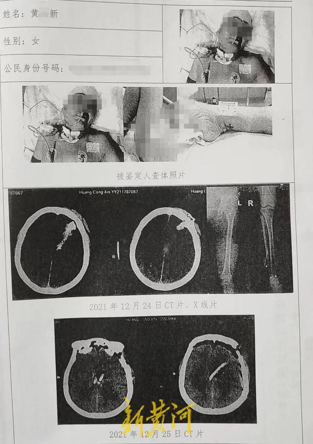 六旬老人遭狩猎者枪击致重伤<strong></p>
<p>原油股票代码</strong>,开枪者两次逃离现场,事发4小时后冒充“好心人”施救,家属:耽误了最佳救治时间