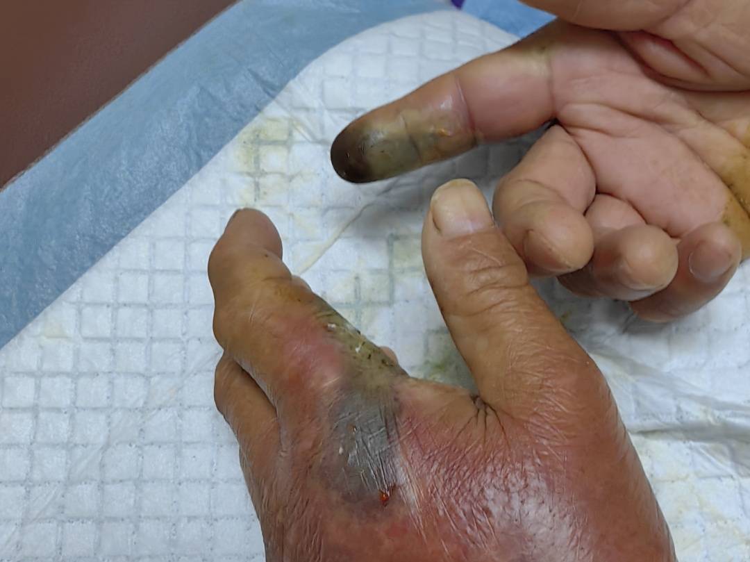 眼镜王蛇咬伤老人<strong></p>
<p>黄金国际价格</strong>,家属拖两米多长的“凶手”冲进医院!“拎蛇就医”可取吗?