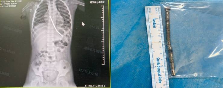 整整40颗<strong></p>
<p>聚查</strong>!湖南3岁男童身体里取出……医生紧急提醒