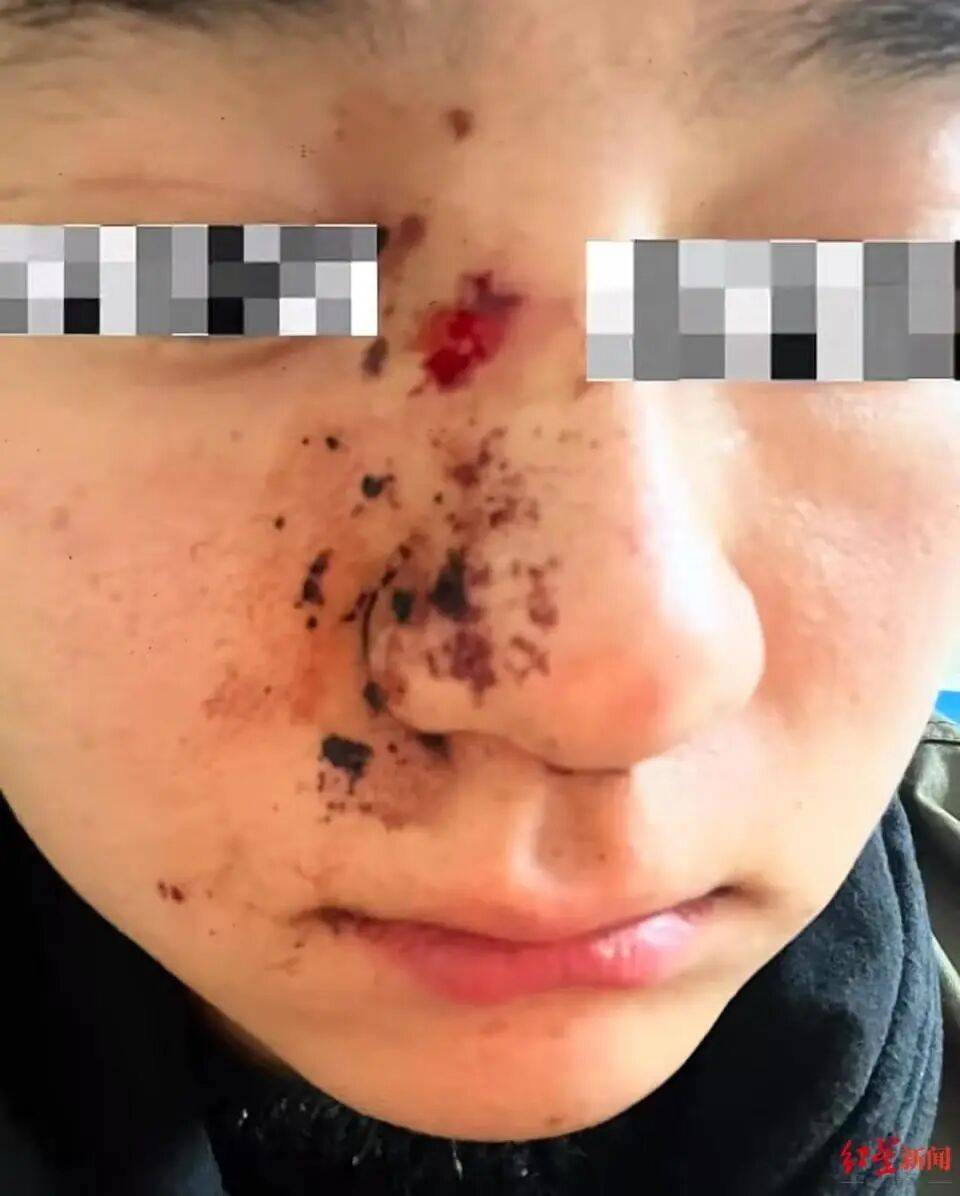 男子因质问女子遛狗不牵绳被打骨折<strong></p>
<p>虚拟币otc走现金交易</strong>，当事人：打人者毫无悔意