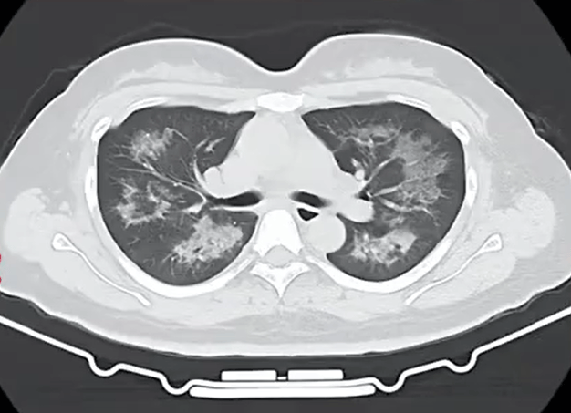 每天用2次<strong></p>
<p>貔貅盘虚拟币</strong>，22岁女主播肺里长满阴影！很多人不注意